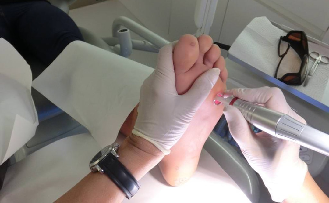 Tìm Hiểu Bệnh Mụn Cóc Là Gì? Nguyên Nhân Gây Ra Và Phương Pháp Điều Trị An Toàn