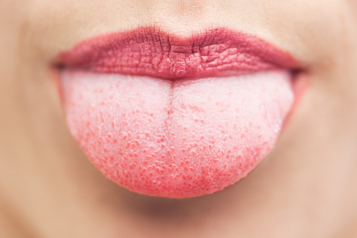 Dấu Hiệu Nhiễm Nấm Candida Sau Quan Hệ Bằng Miệng Và Cách Phòng Ngừa