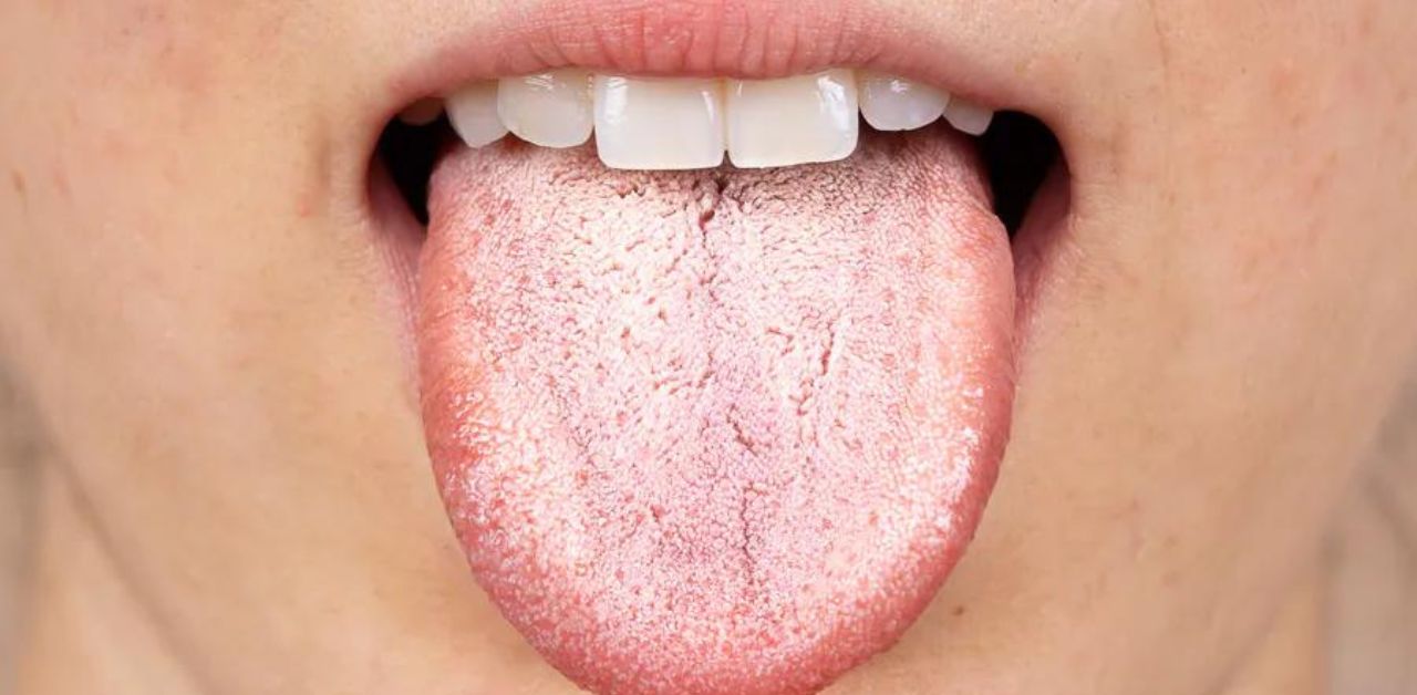 Dấu Hiệu Nhiễm Nấm Candida Sau Quan Hệ Bằng Miệng Và Cách Phòng Ngừa