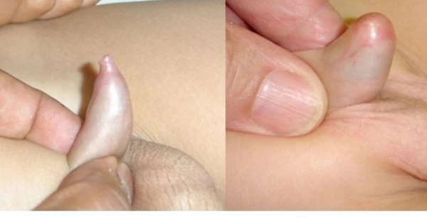 Dính Bao Quy Đầu Có Nguy Hiểm Không? Nguyên Nhân Và Những Điều Cần Biết