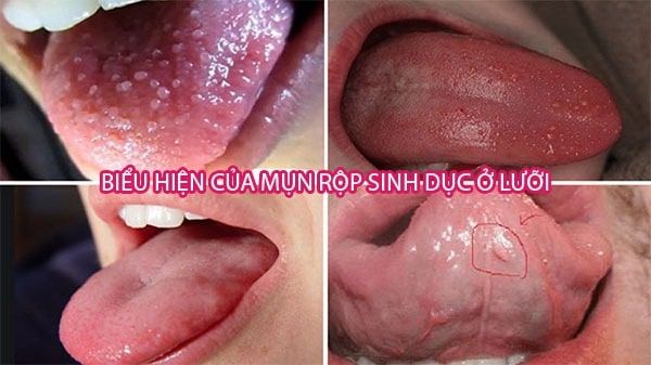 Hôn Nhau Có Lây Bệnh Sùi Mào Gà Không? Sự Thật Là Gì?