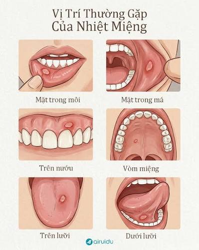 Vì Sao Sau Quan Hệ Bằng Miệng Bị Loét Miệng? Cách Phân Biệt Nhiệt Miệng Và STI