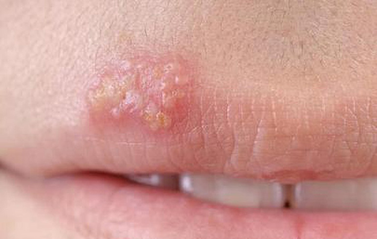 Lỡ Quan Hệ Không Dùng Bao: Tỷ Lệ Có Thai Bao Nhiêu Và Nguy Cơ Mắc Bệnh Gì?