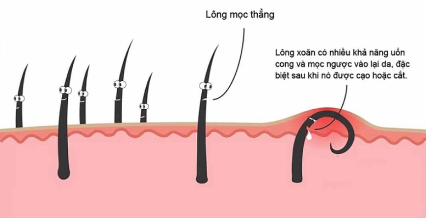 Nhổ Lông Vùng Kín Có Sao Không? Lợi Ích, Rủi Ro Và Cách Làm An Toàn
