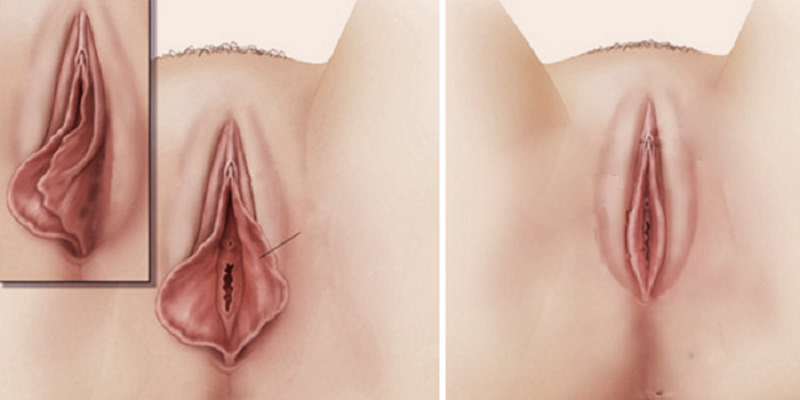 Lâu ngày không quan hệ vùng kín có khít lại không? Sự thật ít người biết