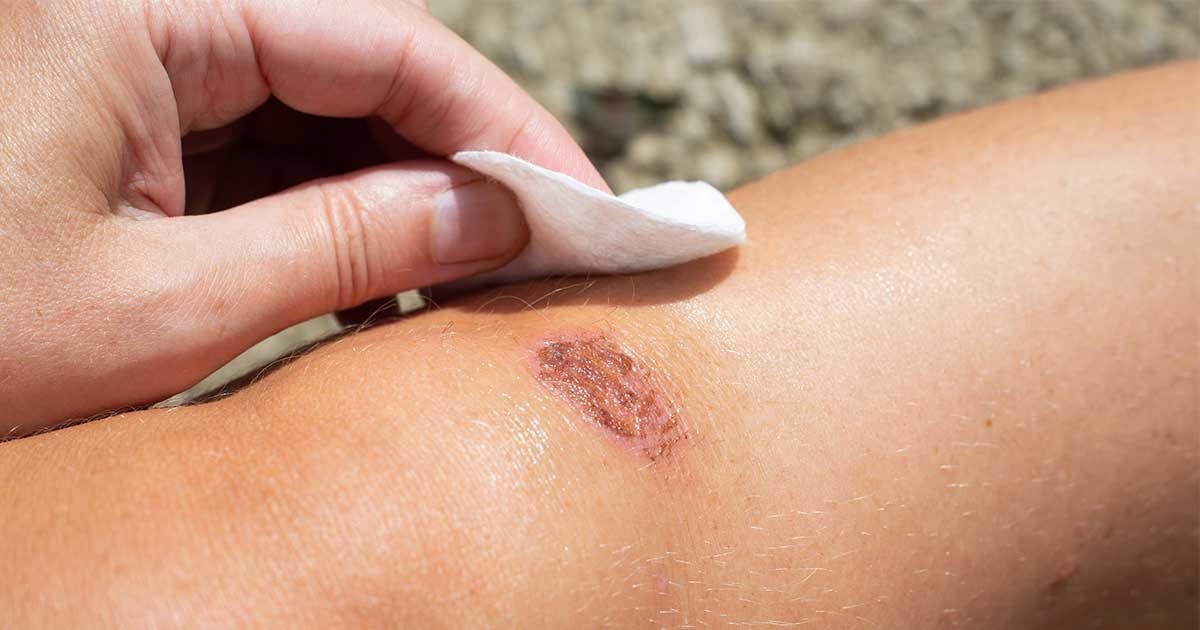 Tìm Hiểu Bệnh Mụn Cóc Là Gì? Nguyên Nhân Gây Ra Và Phương Pháp Điều Trị An Toàn