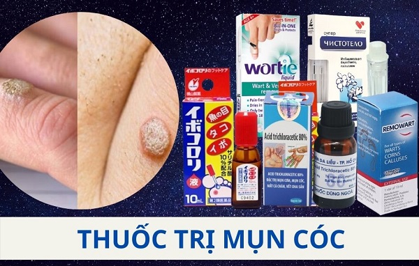 Tìm Hiểu Bệnh Mụn Cóc Là Gì? Nguyên Nhân Gây Ra Và Phương Pháp Điều Trị An Toàn