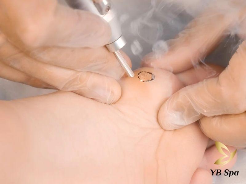 Tìm Hiểu Bệnh Mụn Cóc Là Gì? Nguyên Nhân Gây Ra Và Phương Pháp Điều Trị An Toàn