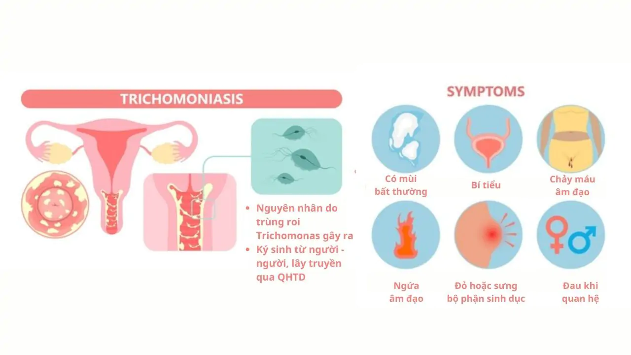 Dấu Hiệu Nhiễm Trichomoniasis Ở Nam Và Nữ Cần Nhận Biết Sớm