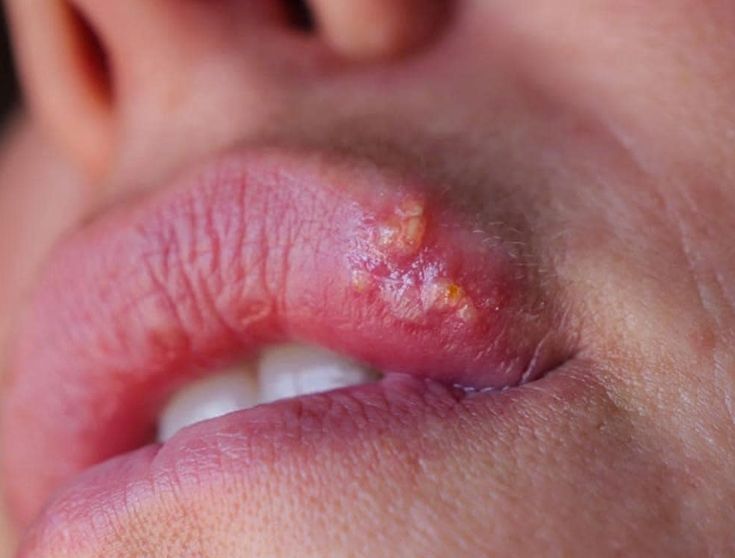 Vi Khuẩn HP Có Gây Hôi Miệng Không? Cách Giảm Mùi Hôi Hiệu Quả