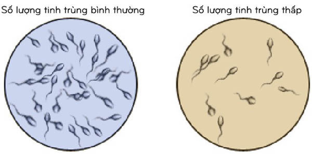 Vô Sinh Có Chữa Khỏi Được Không? Cách Điều Trị Vô Sinh Hiệu Quả Nhất Hiện Nay