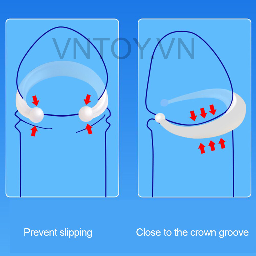 Vòng đeo đầu khấc ngày đêm điều trị xuất tinh sớm cho nam giới