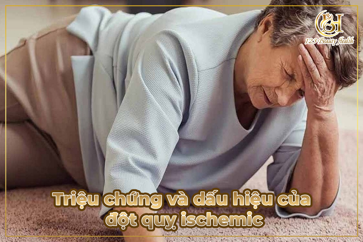 Triệu chứng và dấu hiệu của đột quỵ ischemic