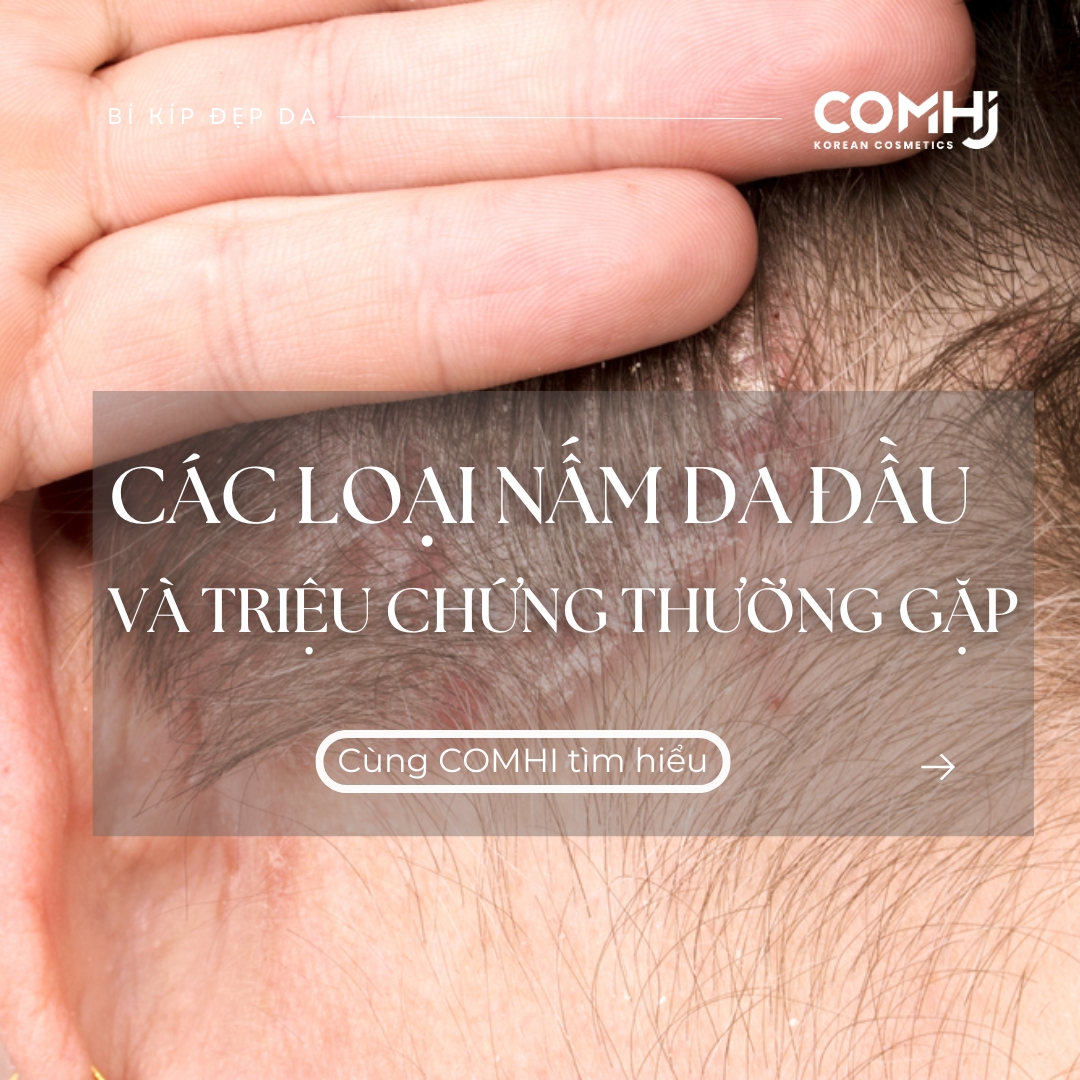 CÁC LOẠI NẤM DA ĐẦU VÀ TRIỆU CHỨNG THƯỜNG GẶP