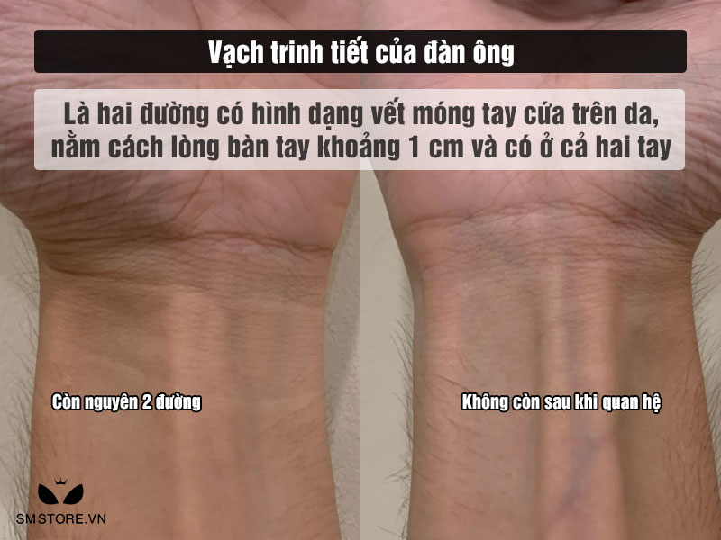 Vạch trinh tiết của đàn ông ở tay