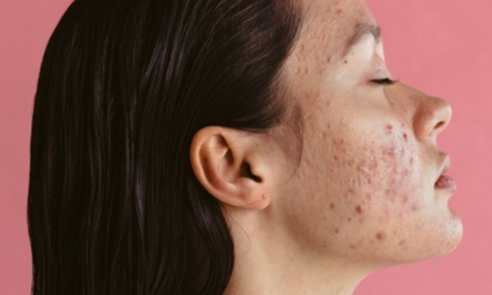 Phân biệt các loại Mụn và cách trị mụn hiệu quả