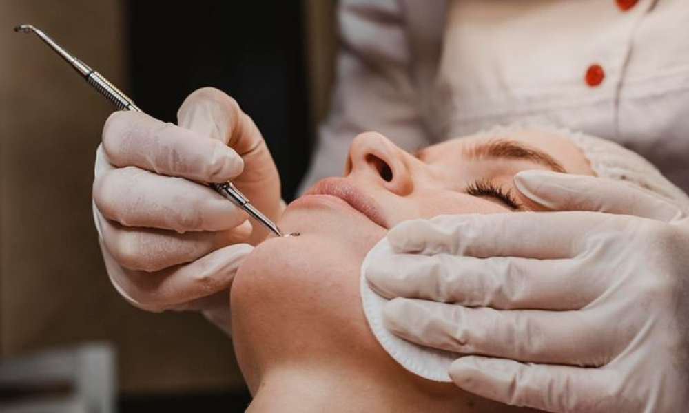 Có nên nặn mụn hay không?