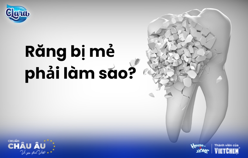 Răng bị mẻ phải làm sao? Cách phục hồi đẹp như mới