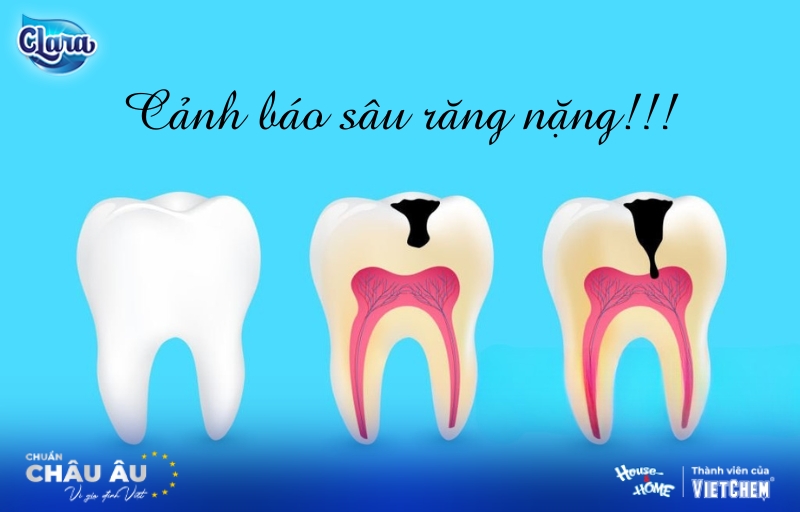 Sâu răng nặng | Cảnh báo tình trạng nguy hiểm không thể xem nhẹ