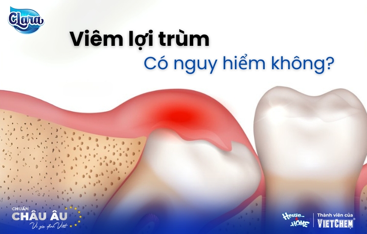 Viêm lợi trùm có nguy hiểm không? Nguyên nhân, dấu hiệu và cách điều trị tại nhà