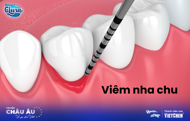 Chớ chủ quan với viêm nha chu – Mối nguy tiềm ẩn với sức khỏe răng miệng