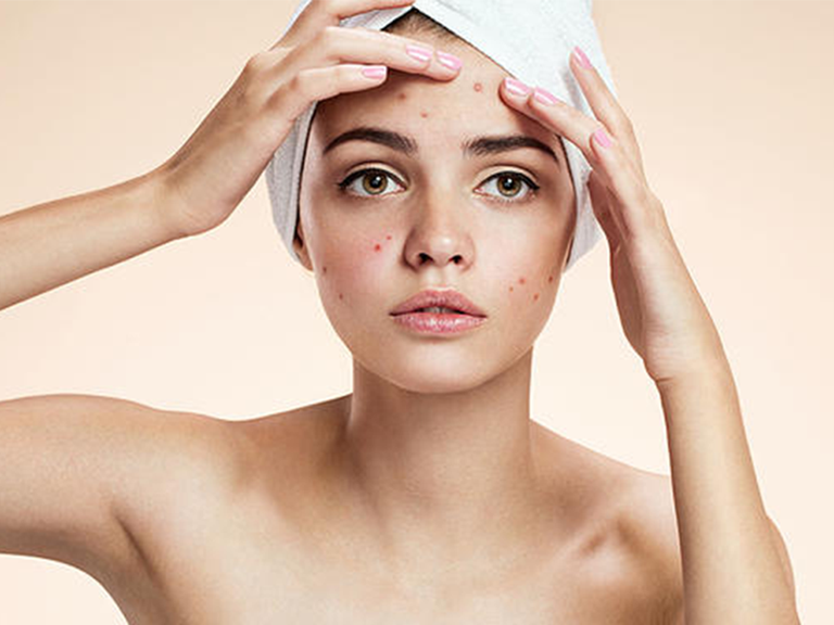 Da còn mụn có nên dùng vitamin C không?