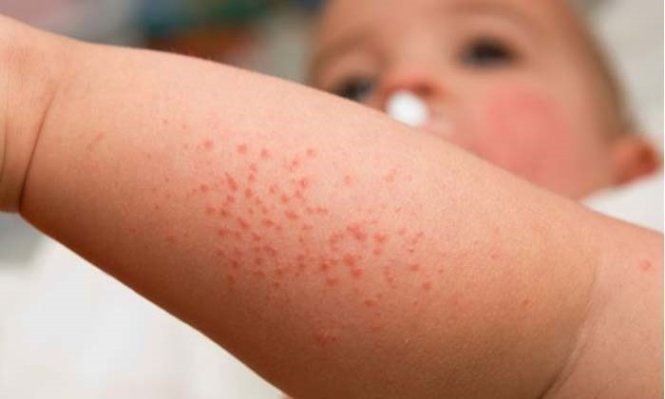 Triệu chứng của sởi là gì và cần cách ly bao nhiêu ngày để tránh lây lan bệnh?