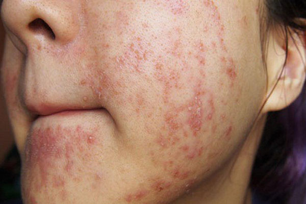 Bôi kem dưỡng da bị rát mặt vì nguyên nhân gì? Giải quyết thế nào?
