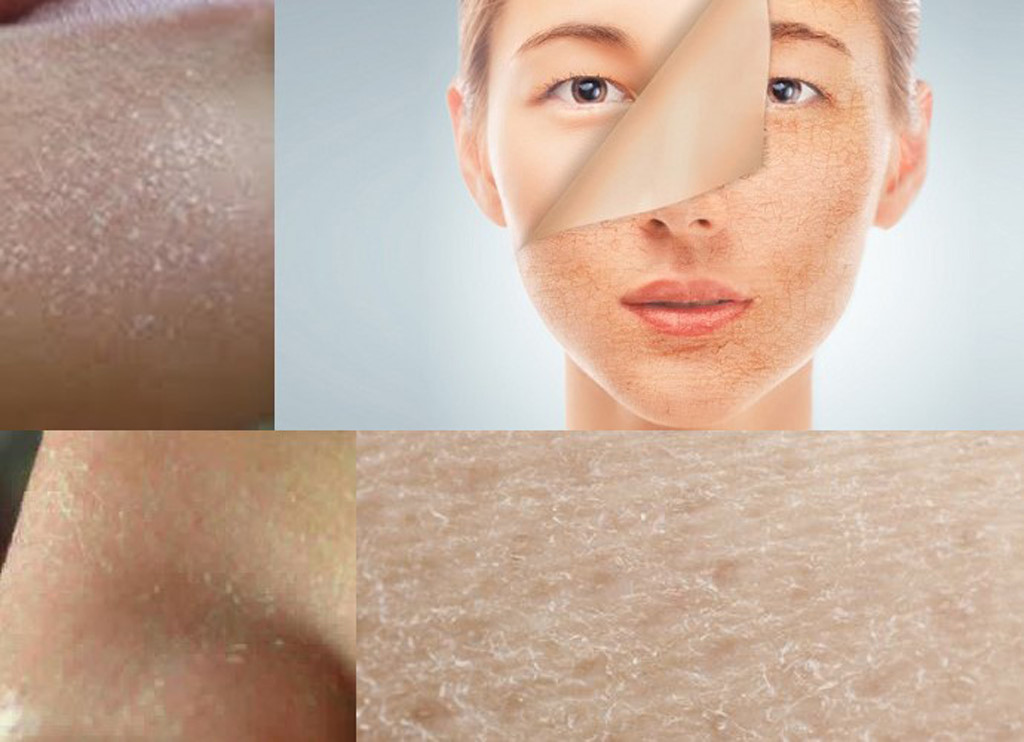 Da mặt sần sùi khô ráp thì nên làm gì?