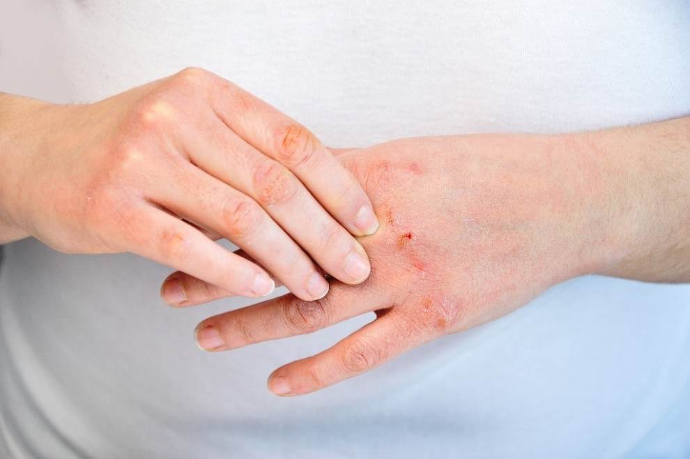 Mẹo hay giúp trị dứt điểm chân tay nứt nẻ ngay tức thì