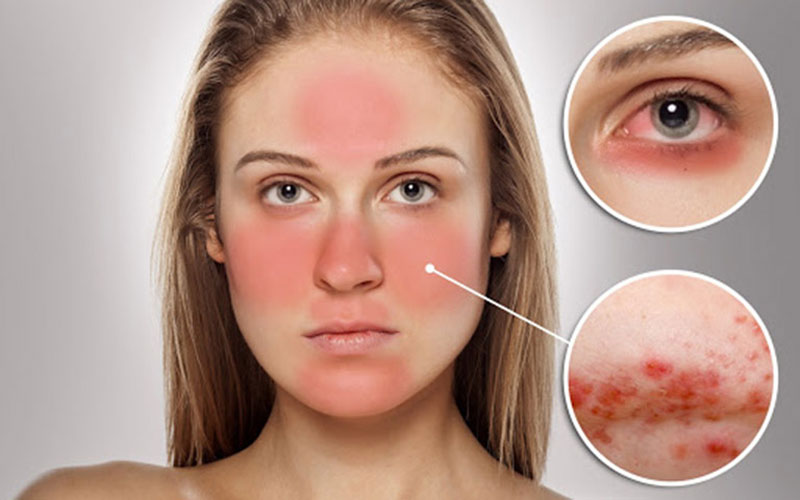 Cách nhận biết da bị kích ứng mỹ phẩm