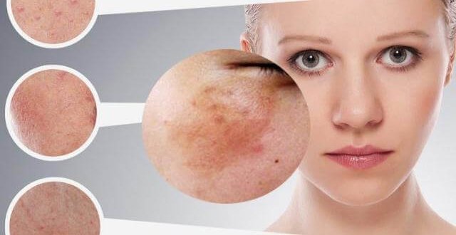 Phân biệt nám da do rối loạn nội tiết tố với nám da thông thường