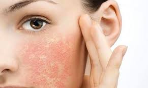 Làn da bị kích ứng có nên dùng kem chống nắng không?