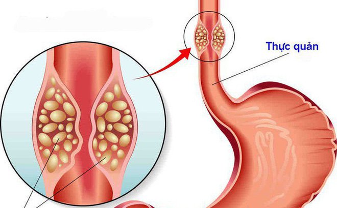 Những dấu hiệu nhận biết bệnh ung thư thực quản – Đừng bỏ qua nếu bạn đang gặp!