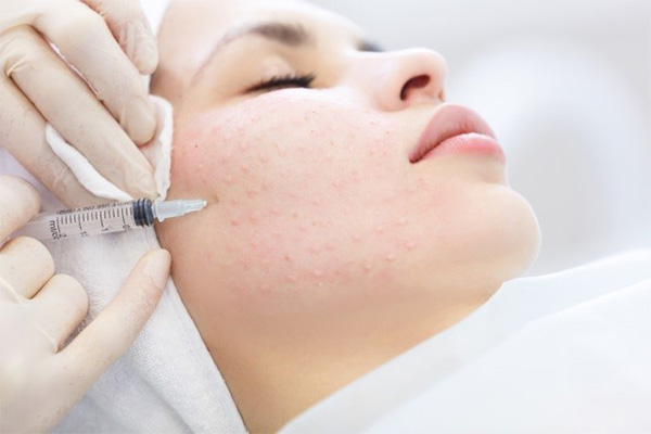 Tiêm meso căng bóng: Những điều bạn cần biết