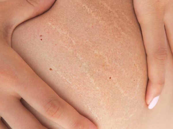 Cách trị rạn da hiệu quả tại nhà ít người biết