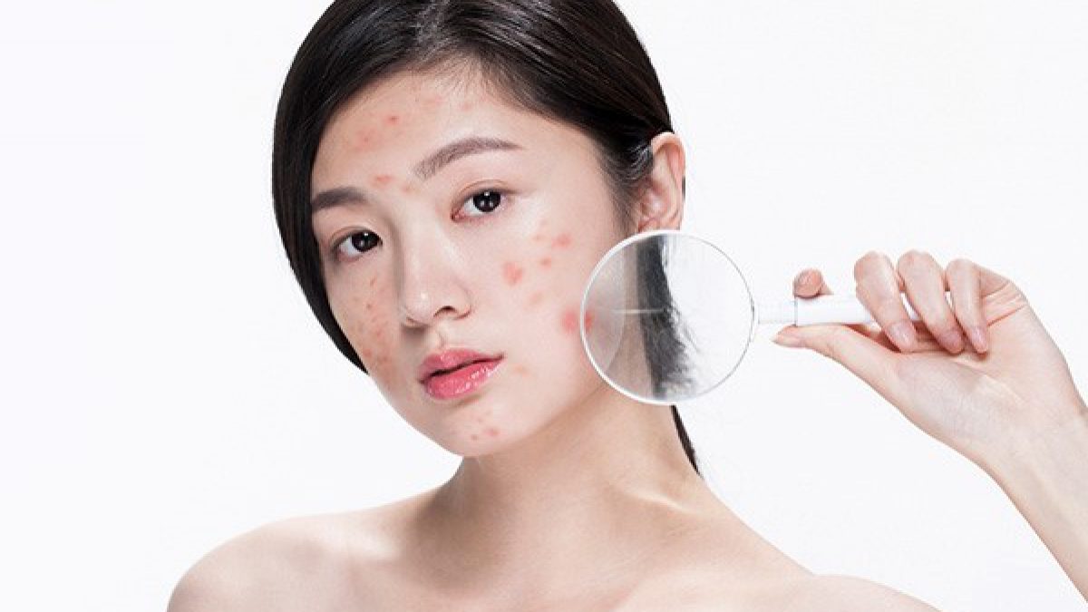 5 Lưu Ý Về Có Nên Việc Dùng Mặt Nạ Ngủ Cho Da Mụn