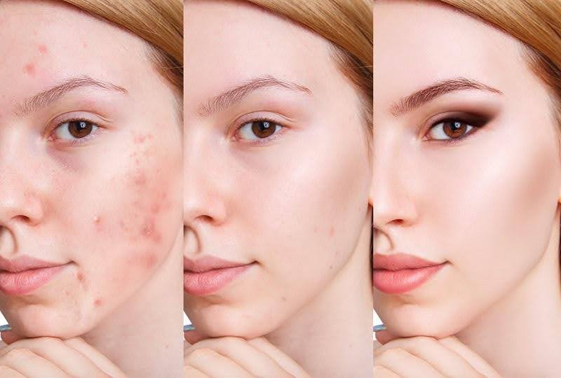 Axit salicylic và Benzoyl peroxide: Cái nào chữa mụn tốt hơn?