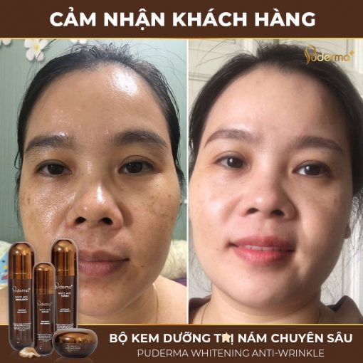[Chính hãng] Bộ Hỗ Trợ Xóa NÁM WHITE JADE PUDERMA: Cấp ẩm, nâng cơ, tái tạo lớp biểu bì, giúp da trắng sáng, mịn màng.