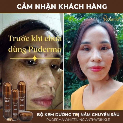 [Chính hãng] Bộ Hỗ Trợ Xóa NÁM WHITE JADE PUDERMA: Cấp ẩm, nâng cơ, tái tạo lớp biểu bì, giúp da trắng sáng, mịn màng.
