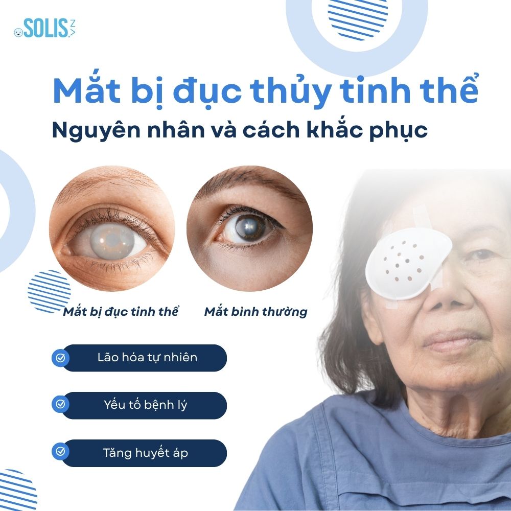 Mắt bị đục thủy tinh thể: Nguyên nhân và cách điều trị Mắt bị đục thủy tinh thể: Nguyên nhân và cách điều trị