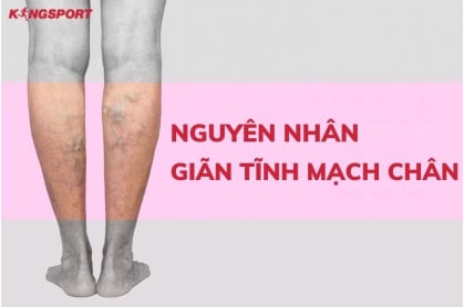 NGUYÊN NHÂN GIÃN TĨNH MẠCH CHÂN VÀ CÁCH PHÒNG NGỪA HIỆU QUẢ