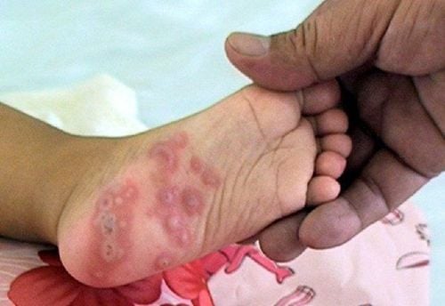 CÁC DẤU HIỆU BỊ CHÂN TAY MIỆNG Ở TRẺ VÀ BIỆN PHÁP PHÒNG TRÁNH