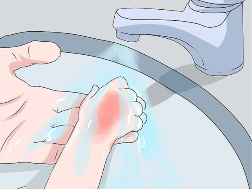 Mẹo hay áp dụng cách trị bỏng tại nhà