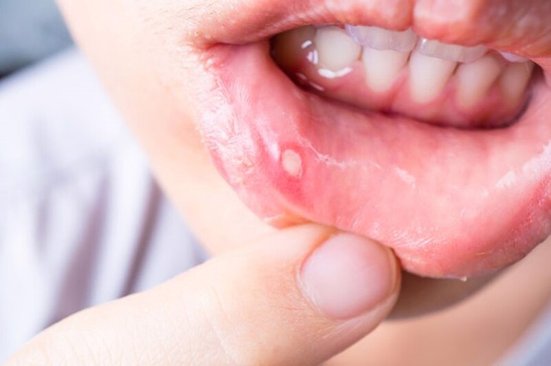 ĐIỂM DANH NGAY 5 MẸO CHỮA NHIỆT MIỆNG ĐƠN GIẢN NHẤT