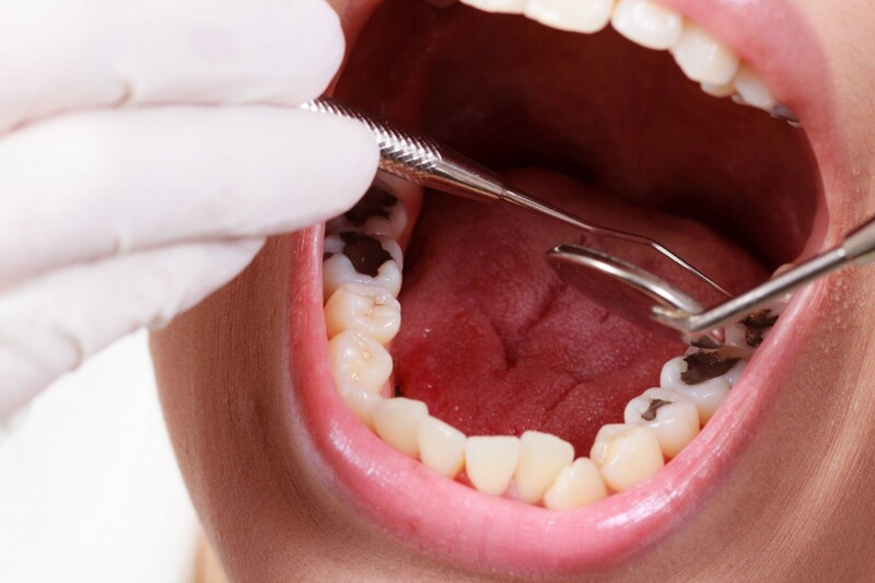 10  trị nhức răng tại nhà đơn giản, hiệu quả