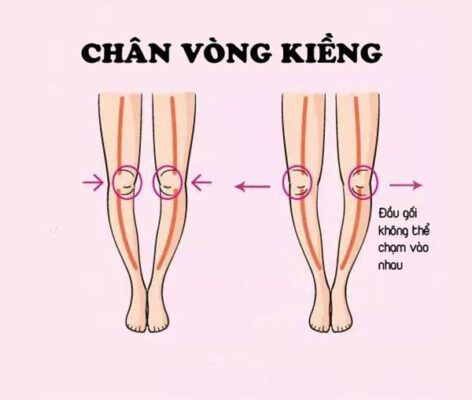 10 cách chữa chân vòng kiềng cho người lớn tại nhà đơn giản