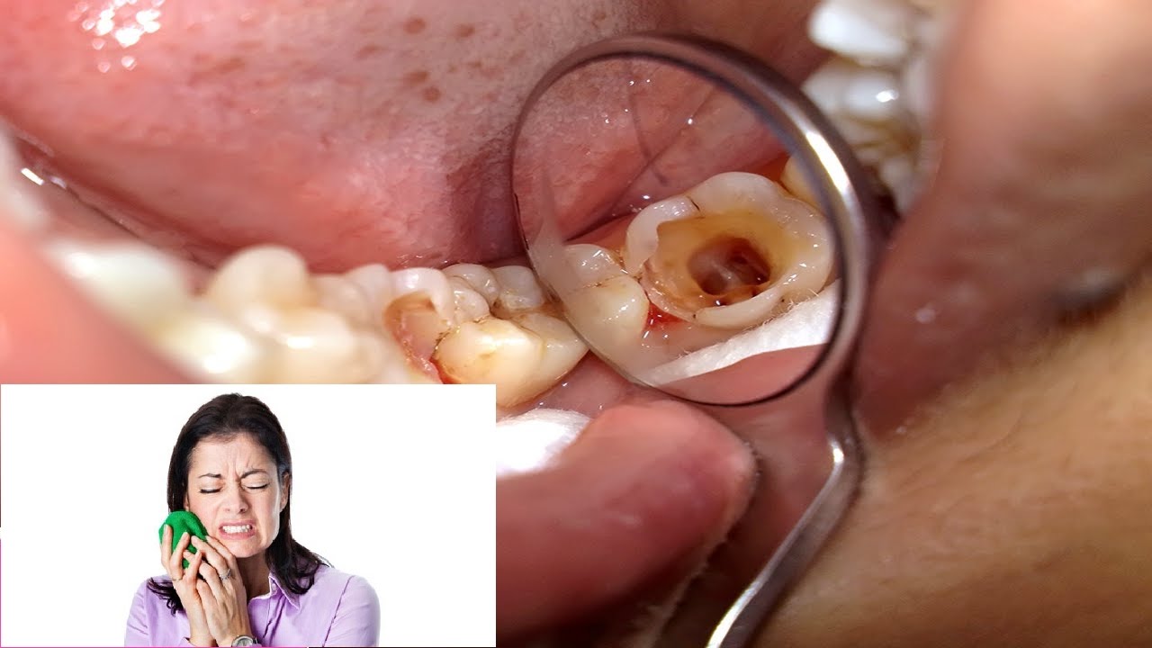 Nhức răng và 10 cách trị nhức răng nhanh hết ngay tại nhà