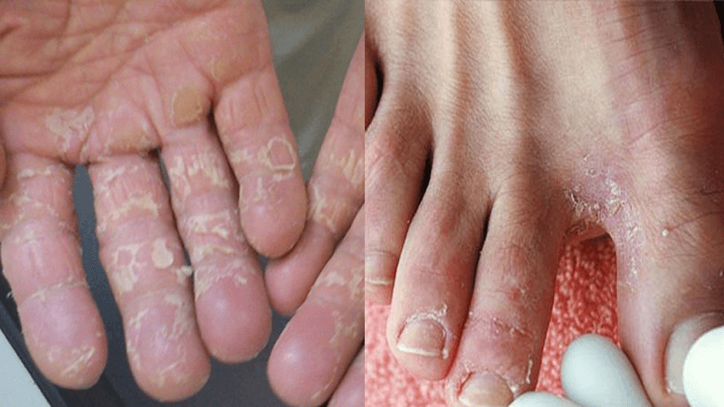 10 mẹo trị nước ăn chân cực đơn giản và hiệu quả ngay tại nhà