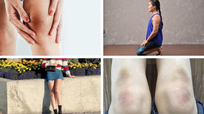 Mẹo trị thâm đầu gối hiệu quả chỉ với nguyên liệu dễ kiếm